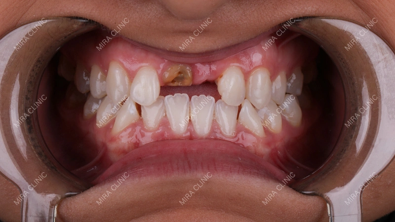 teeth are missing in one jaw